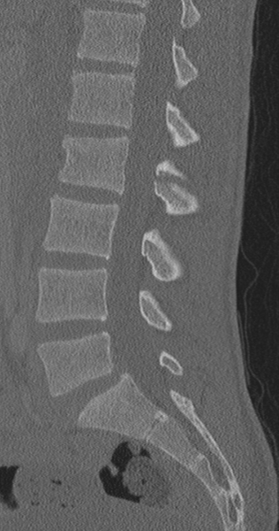File:Chance fracture (Radiopaedia 40360-42912 Sagittal bone window 50).png