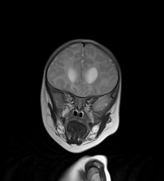 File:Chiari III malformation with occipital encephalocele (Radiopaedia 79446-92559 Coronal T2 26).jpg