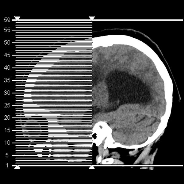 File:Chiasmatic-hypothalamic juvenile pilocytic astrocytoma (Radiopaedia 78533-91237 Axial non-contrast 1).jpg