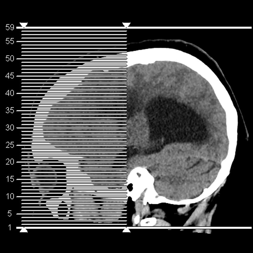 Chiasmatic-hypothalamic juvenile pilocytic astrocytoma (Radiopaedia 78533-91237 Axial non-contrast 1).jpg