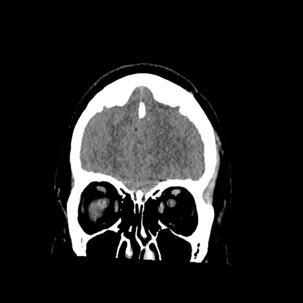 File:Chiasmatic-hypothalamic juvenile pilocytic astrocytoma (Radiopaedia 78533-91237 Coronal non-contrast 16).jpg