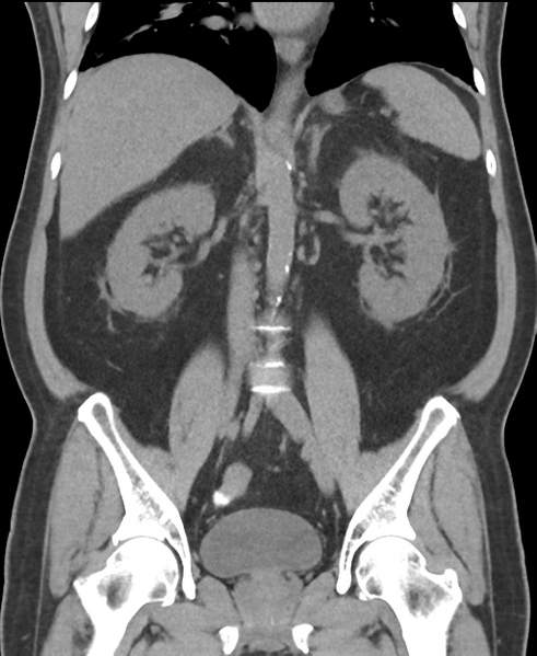 File:Cholecystitis with focal perforation and hepatic abscess (Radiopaedia 37189-38945 Coronal non-contrast 35).png