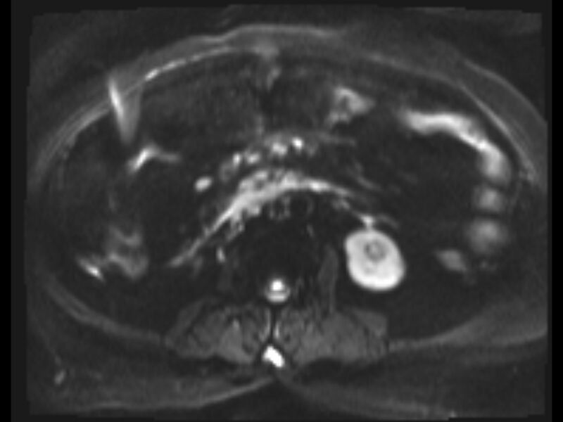 File:Choledocholithiasis causing intrahepatic biliary duct dilation (Radiopaedia 39908-42369 Axial T2 SPAIR 1).jpg