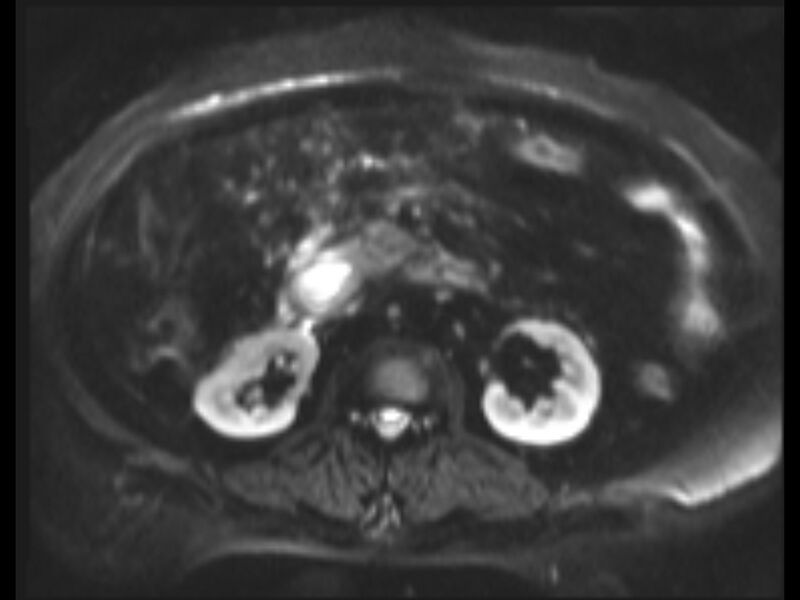File:Choledocholithiasis causing intrahepatic biliary duct dilation (Radiopaedia 39908-42369 Axial T2 SPAIR 5).jpg