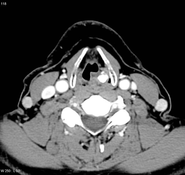 File:Chondrosarcoma - larynx (Radiopaedia 4588-6698 A 3).jpg