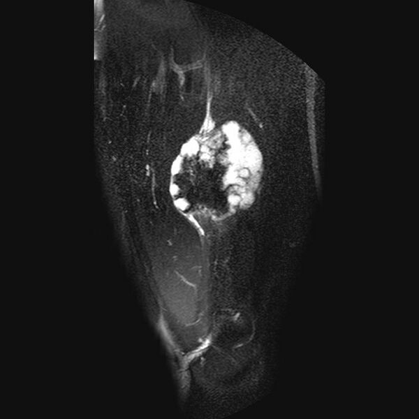 File:Chondrosarcoma arising from exostosis (Radiopaedia 59996-67686 C 6).jpg