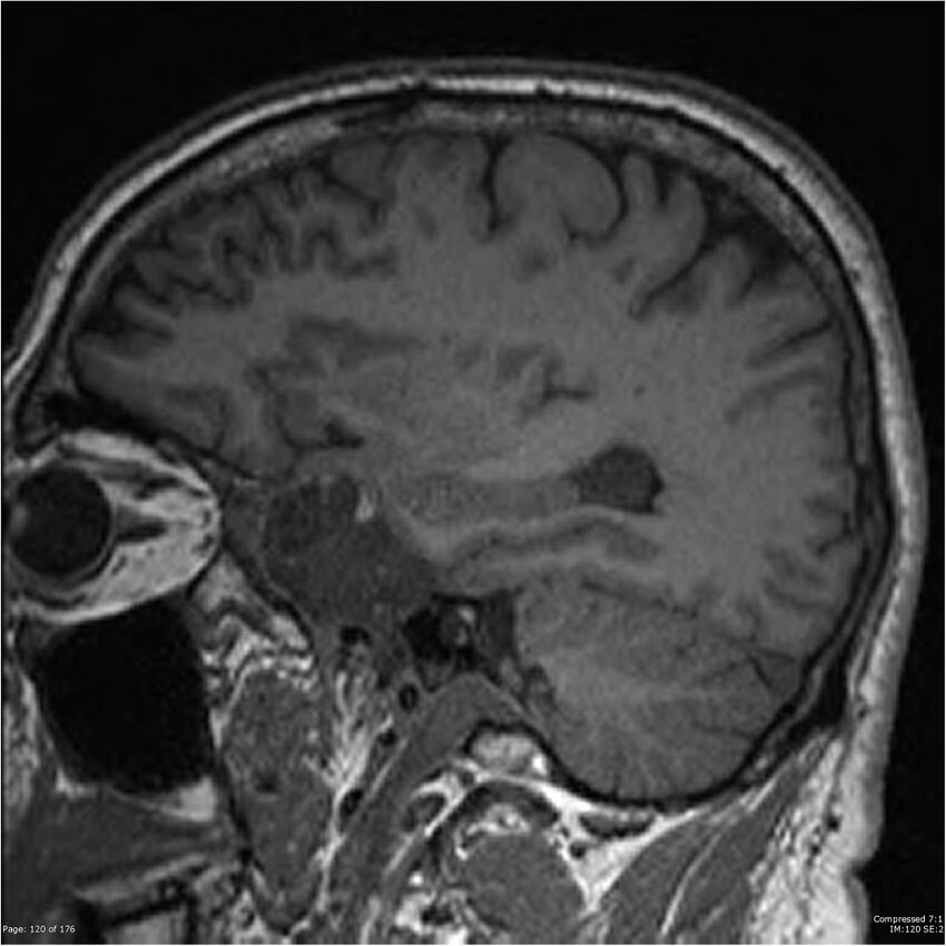 Chondrosarcoma of skull base- grade II (Radiopaedia 40948-43654 Sagittal T1 43).jpg