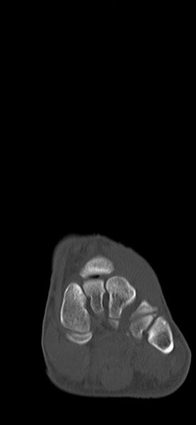 File:Chopart fracture (Radiopaedia 35347-36851 Coronal bone window 51).jpg