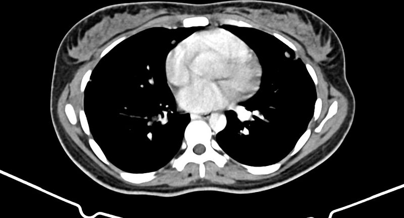 File:Choriocarcinoma liver metastases (Radiopaedia 74768-85766 A 4).jpg