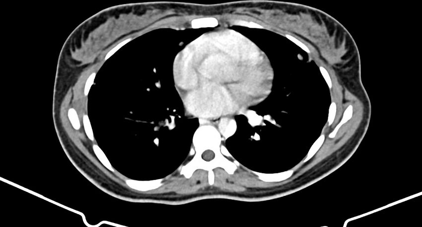 Choriocarcinoma liver metastases (Radiopaedia 74768-85766 A 4).jpg