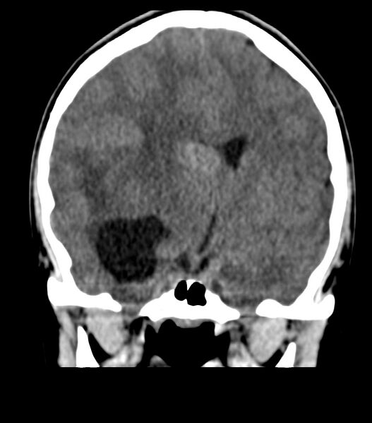 File:Choroid plexus carcinoma (Radiopaedia 91013-108552 Coronal non-contrast 39).jpg