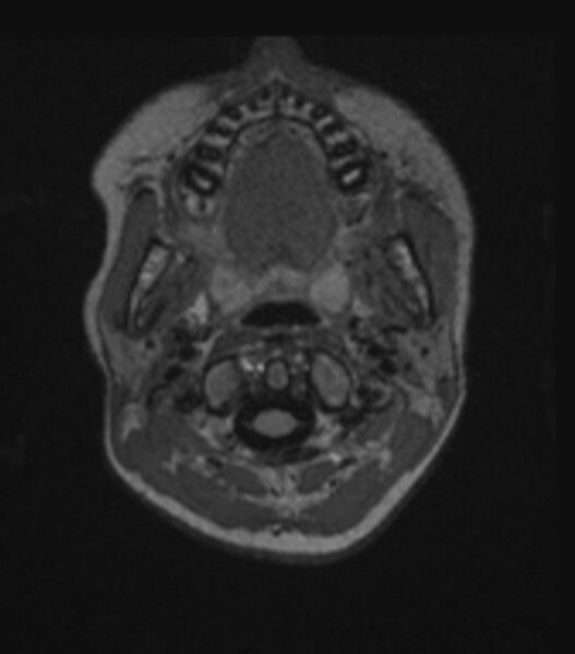 File:Choroid plexus carcinoma (Radiopaedia 91013-108553 Axial FLAIR C+ 54).jpg