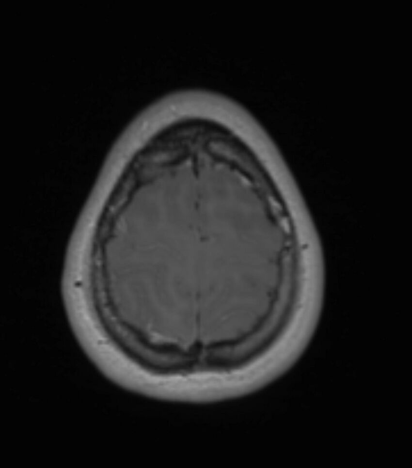 Choroid plexus carcinoma (Radiopaedia 91013-108553 Axial T1 C+ 191).jpg