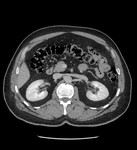 File:Chromophobe renal cell carcinoma (Radiopaedia 86879-103083 C 55).jpg