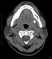 Chronic Submandibular sialolithiasis (Radiopaedia 16880-16606 Axial non-contrast 12).jpg