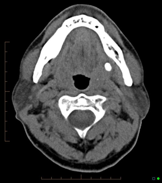 File:Chronic Submandibular sialolithiasis (Radiopaedia 16880-16606 Axial non-contrast 12).jpg