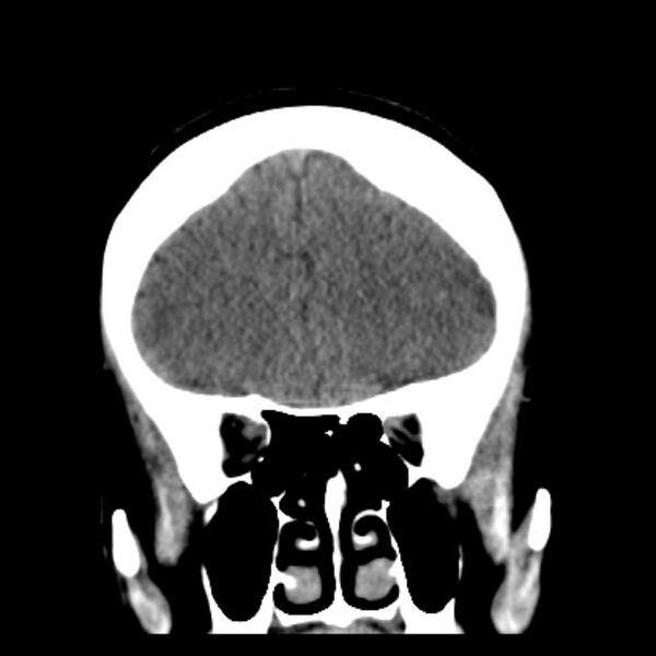 File:Chronic bilateral occipital lobe infarcts (Radiopaedia 31276-31996 Coronal non-contrast 15).jpg