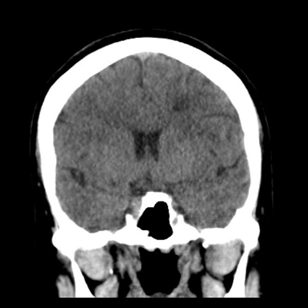 File:Chronic bilateral occipital lobe infarcts (Radiopaedia 31276-31996 Coronal non-contrast 22).jpg
