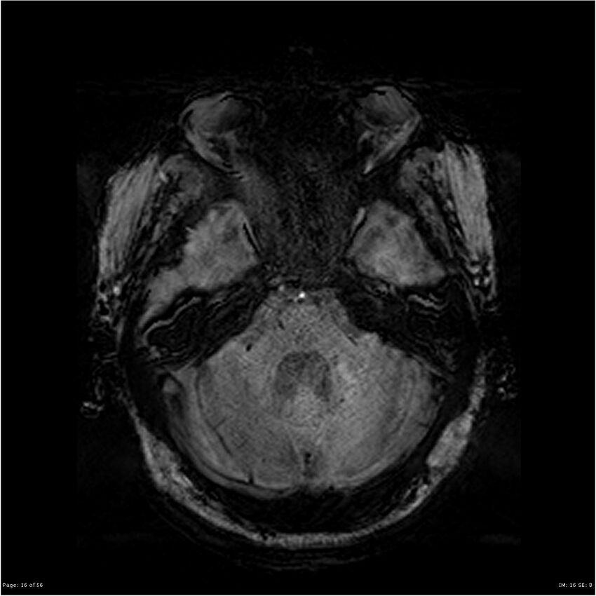 Chronic hypertensive encephalopathy (Radiopaedia 25764-25918 Axial SWI 16).jpg