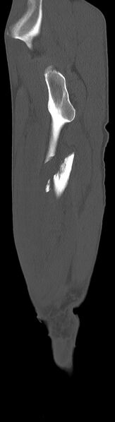 File:Chronic osteomyelitis (with sequestrum) (Radiopaedia 74813-85822 C 92).jpg
