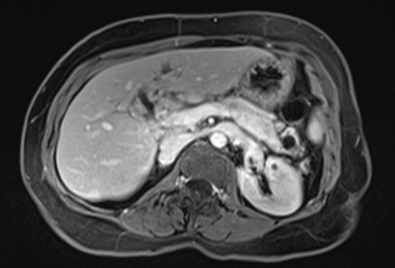 File:Chronic pancreatitis - pancreatic duct calculi (Radiopaedia 71818-82250 Axial T1 C+ fat sat 25).jpg