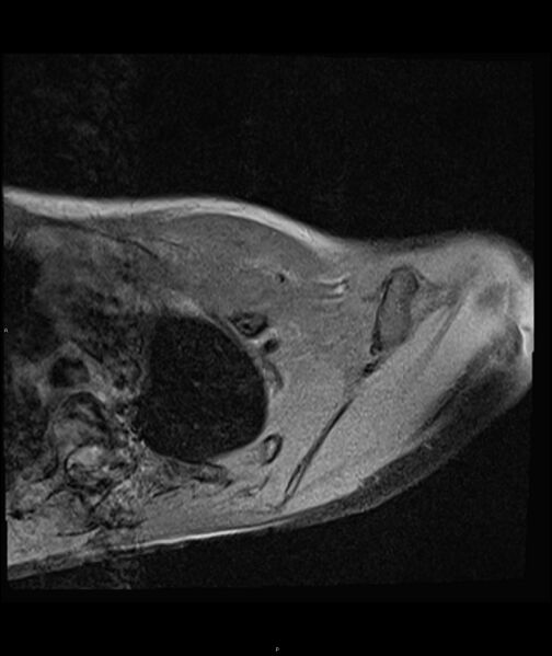File:Chronic reactive multifocal osteomyelitis (CRMO) - clavicle (Radiopaedia 56406-63071 Axial T1 fat sat 12).jpg