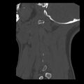 Clay-shoveler fracture (Radiopaedia 22568-22590 Sagittal bone window 44).jpg