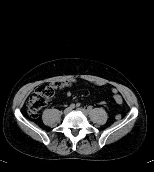 File:Clear cell renal cell carcinoma (Radiopaedia 85006-100539 Axial non-contrast 60).jpg