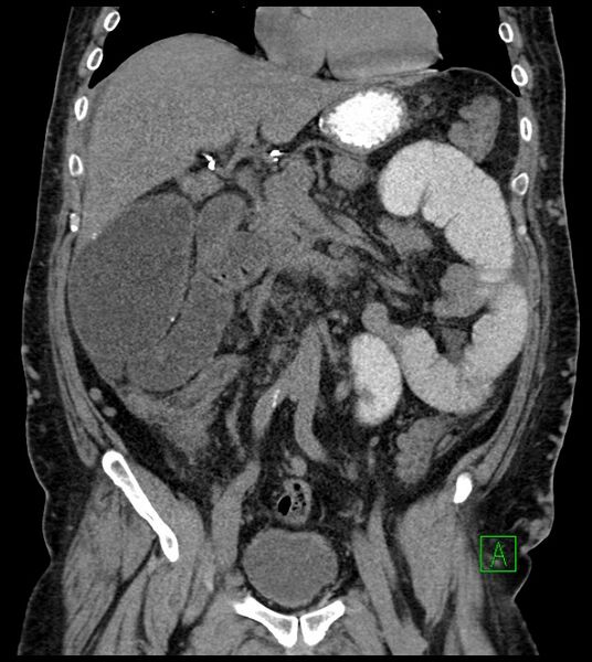 File:Closed-loop small bowel obstruction-internal hernia (Radiopaedia 78439-91096 Coronal non-contrast 47).jpg