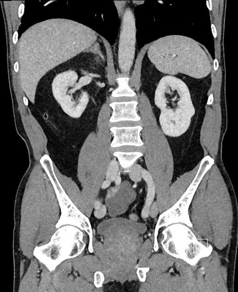 File:Closed loop small bowel obstruction - internal hernia (Radiopaedia 57806-64778 A 69).jpg