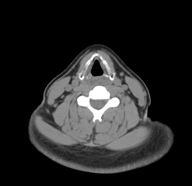 File:Colloid cyst of thyroid (Radiopaedia 22897-22923 Axial non-contrast 31).jpg