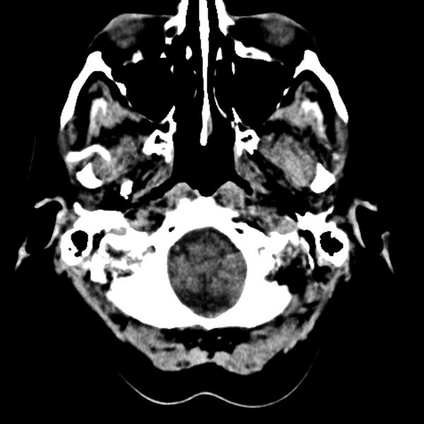File:Colloid cyst with hydrocephalus (Radiopaedia 9373-10064 Axial non-contrast 1).jpg