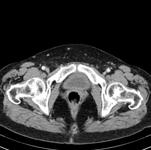 File:Colon carcinoma with hepatic metastases (Radiopaedia 29477-29961 A 113).jpg
