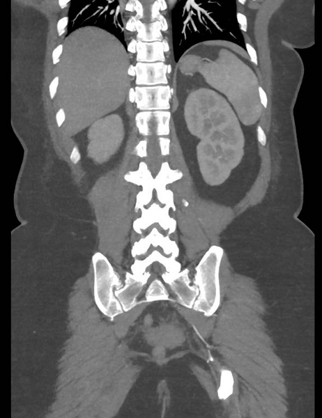 File:Colonic pseudo-obstruction (Radiopaedia 79752-92980 B 46).png