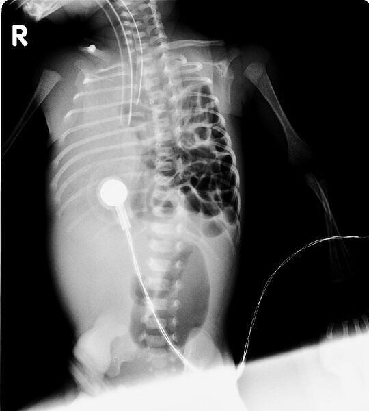 File:Congenital diaphragmatic hernia (Radiopaedia 7392).jpg