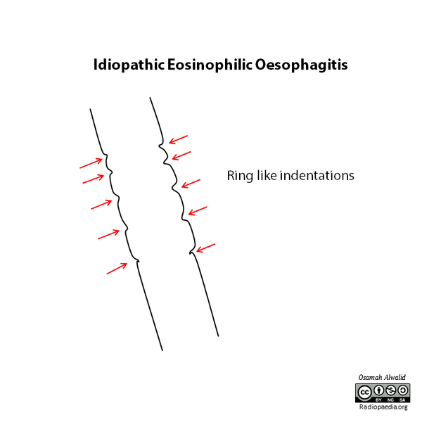 File:Idiopathic eosinophilic esophagitis (illustration) (Radiopaedia 60235).png