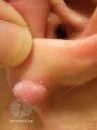 Keloid scar (DermNet NZ site-age-specific-ear-earlobe-keloid).jpg