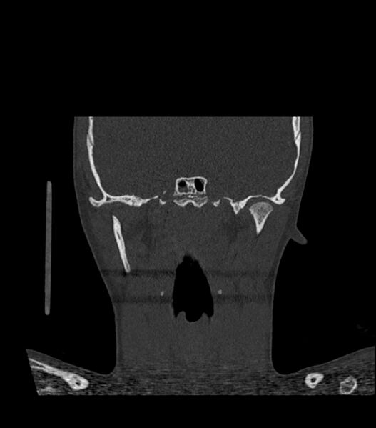 File:Nasoorbitoethmoid fracture (Radiopaedia 90044-107205 Coronal bone window 88).jpg