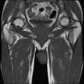 Necrotizing epididymo-orchitis with intra-testicular abscess (Radiopaedia 29397-29860 Coronal T1 16).jpg