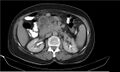 Necrotizing pancreatitis (Radiopaedia 20595-20495 Axial C+ delayed 17).jpg