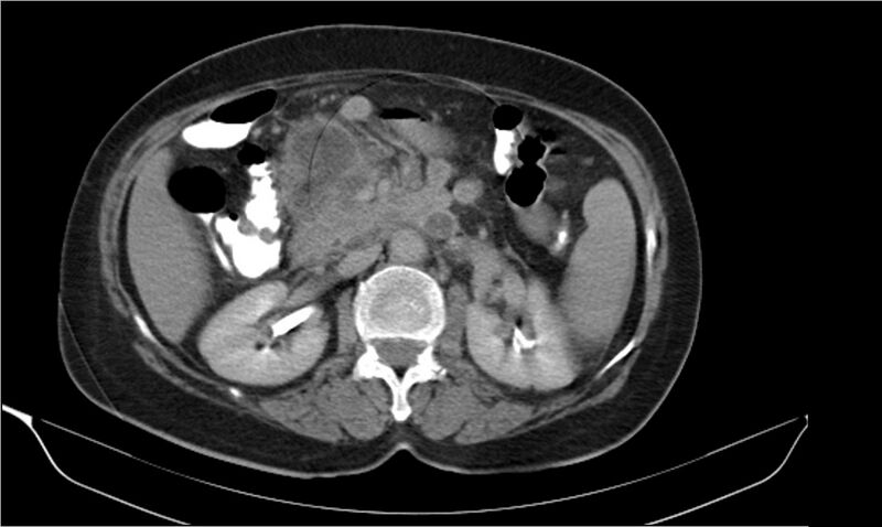 File:Necrotizing pancreatitis (Radiopaedia 20595-20495 Axial C+ delayed 17).jpg