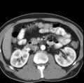 Necrotizing pancreatitis with acute necrotic collection (Radiopaedia 14470-14417 B 19).jpg