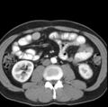 Necrotizing pancreatitis with acute necrotic collection (Radiopaedia 14470-14417 B 28).jpg