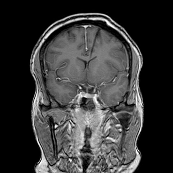 File:Neurofibromatosis type 2 (Radiopaedia 67470-76871 Coronal T1 C+ 11).jpg
