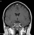 Neurosarcoidosis (Radiopaedia 10930-17204 Coronal T1 C+ 8).jpg