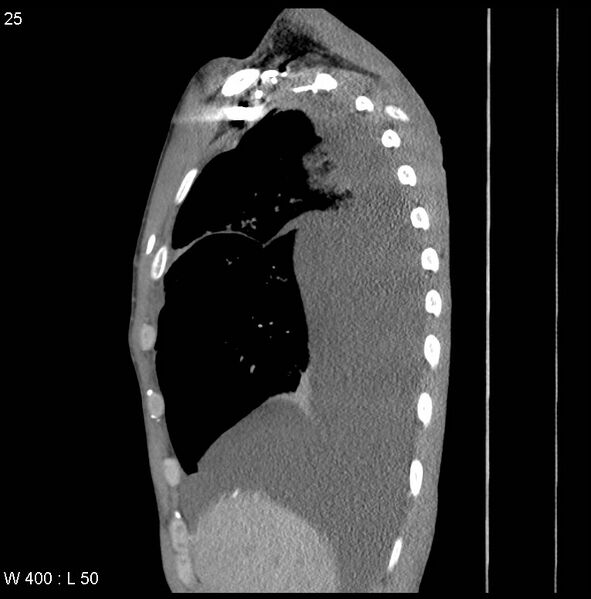 File:Non-Hodgkin lymphoma involving lung (Radiopaedia 29094-29470 D 16).jpg
