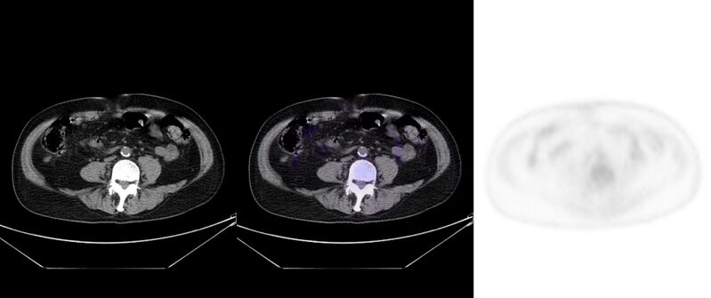 File:Non-Hodgkin lymphoma involving seminal vesicles with development of interstitial pneumonitis during Rituximab therapy (Radiopaedia 32703-33752 ax CT Fus PET 47).jpg