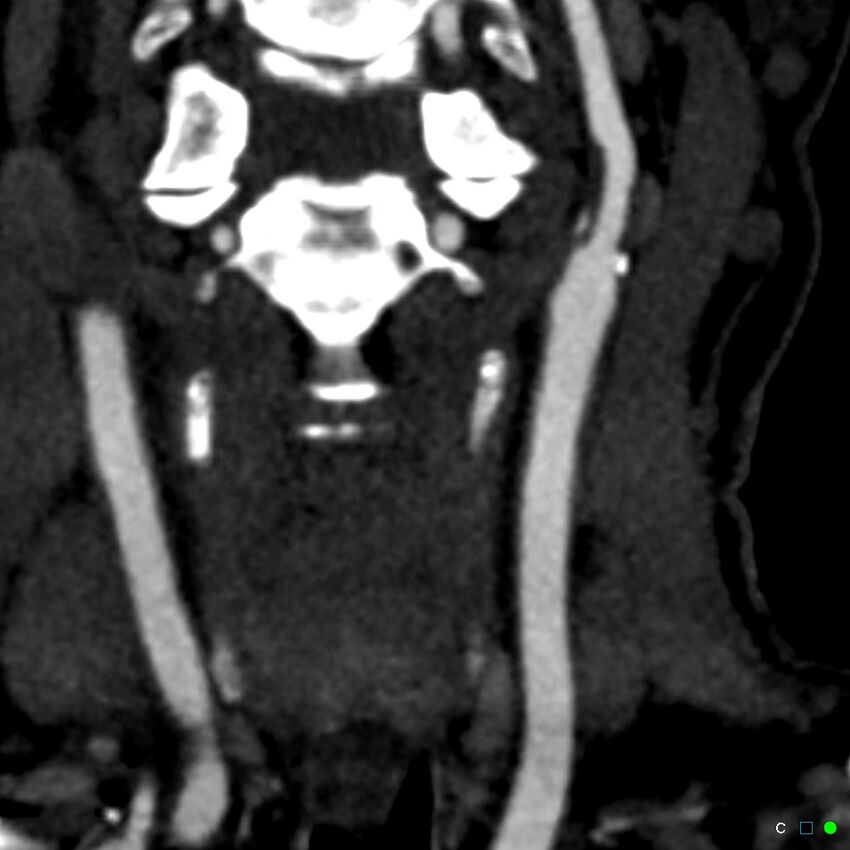 Non-occlusive intraluminal internal carotid artery thrombus (Radiopaedia 37751-39658 C 73).jpg