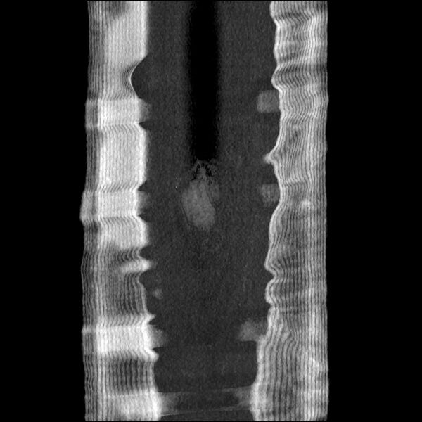 File:Normal CT angiogram of pelvis (Radiopaedia 45390-49430 B 50).jpg