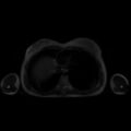 Normal MRI abdomen in pregnancy (Radiopaedia 88001-104541 Axial T2 2).jpg